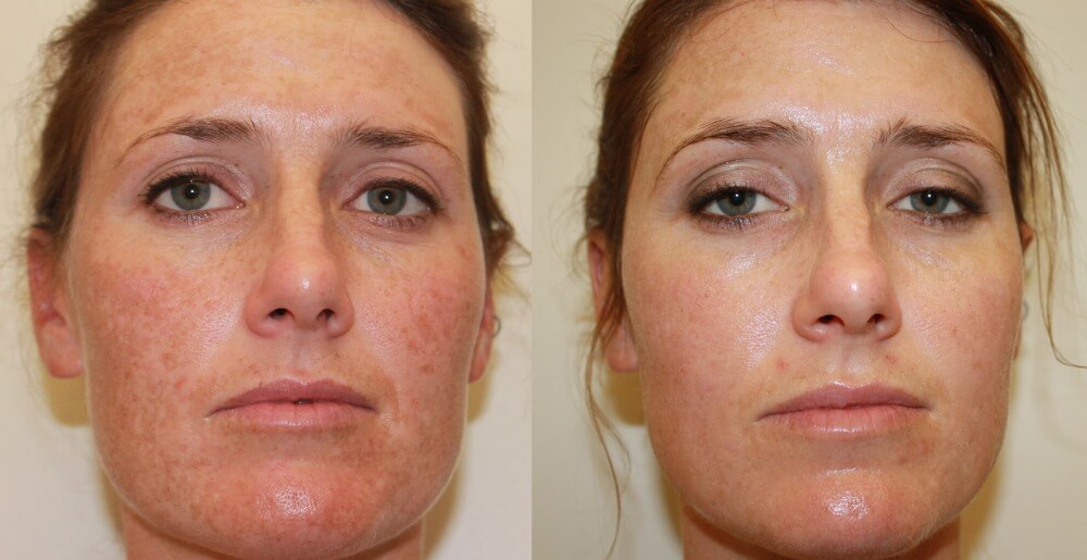 Sun Damage treatment before and after