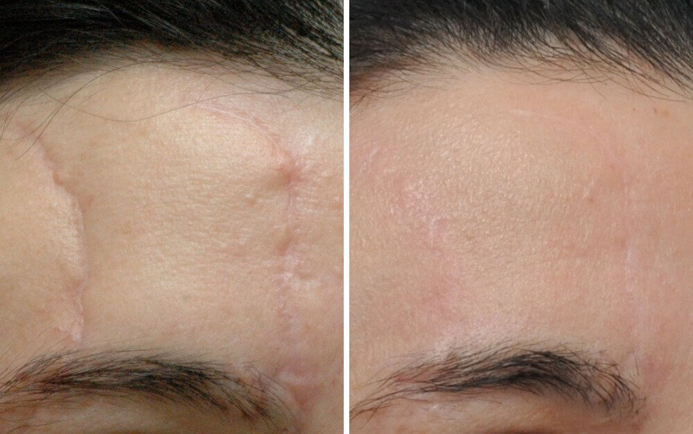 Before & After - NW LASER