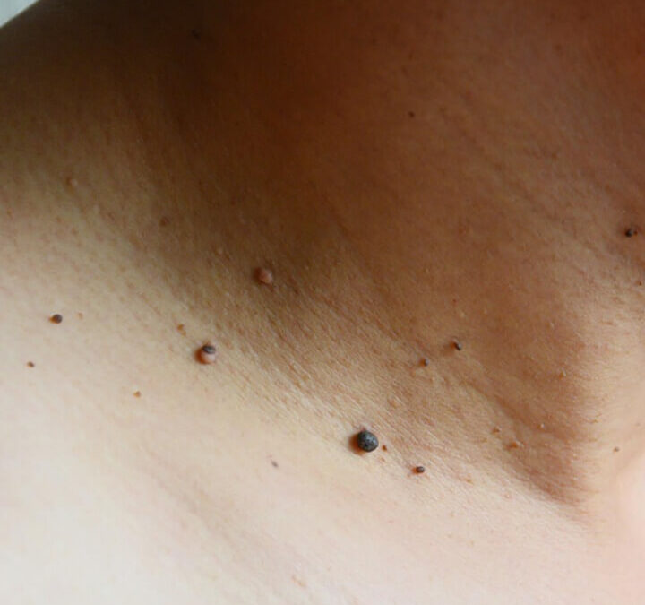 Skin tags moles warts removal