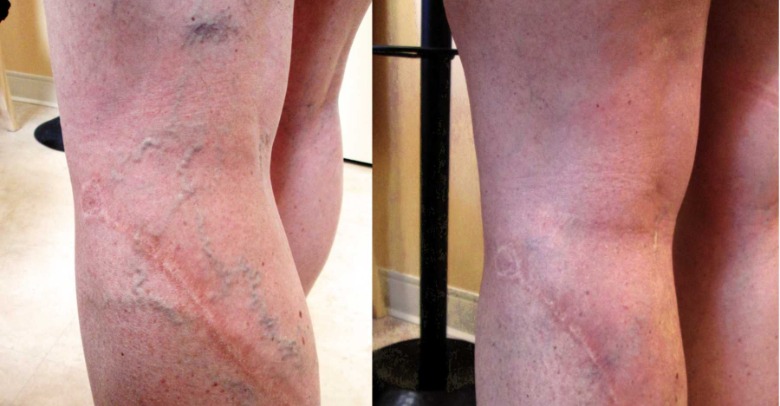 Sclerotherapy results