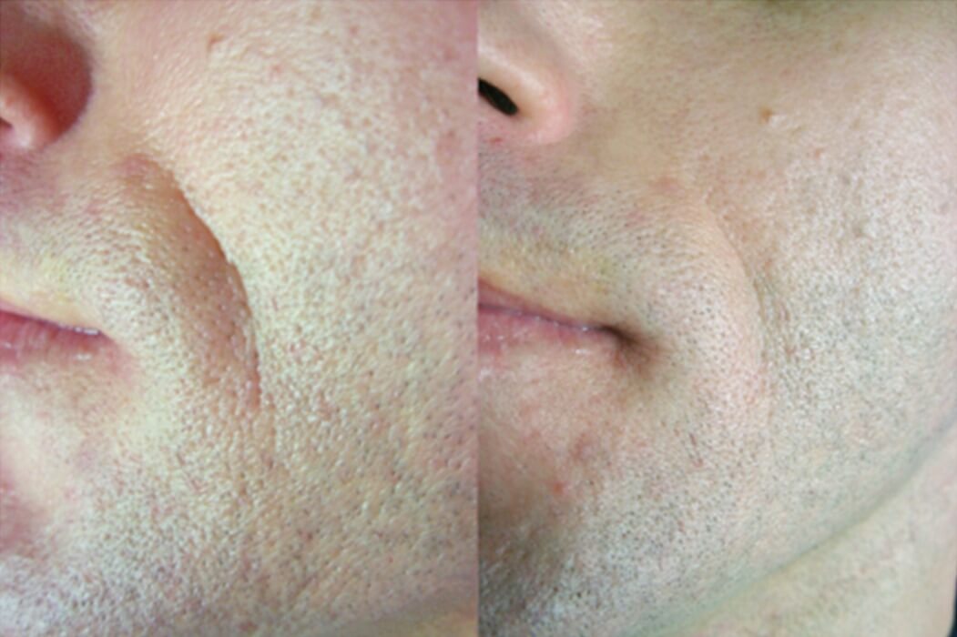 Pelleve skin tightening before and after
